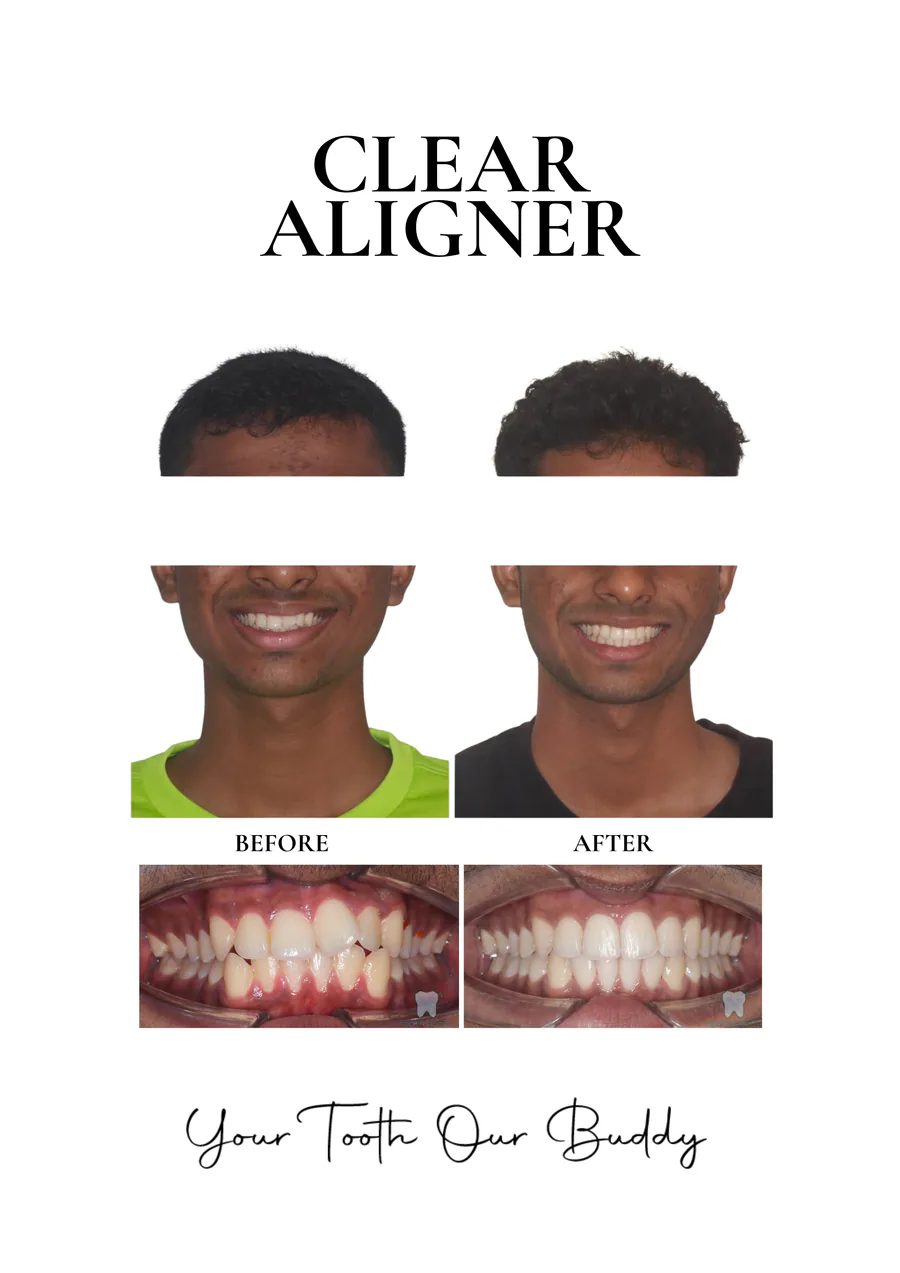 Clear aligner treatment result 3, before and after comparison.